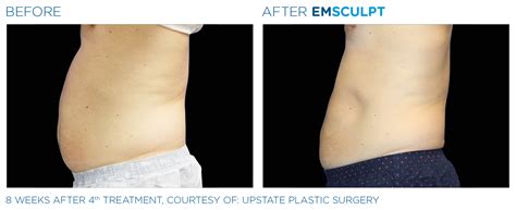 emsculpt las vegas|Emsculpt Las Vegas, NV .